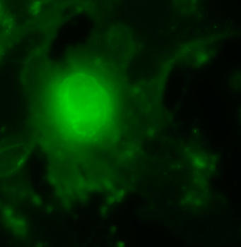 Célula tumoral infectada con NDV no recombinante. Imagen: Enrique Villar.