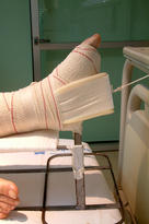 La diabates produce heridas en los pies que tienen difícil cicatrización y son un foco de infecciones