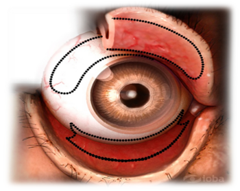 Zonas estudiadas del ojo: la bulvar superior, la tarsal superior y el fórnix inferior.