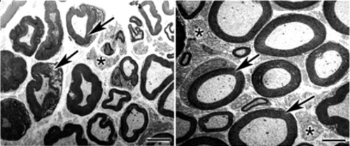 A medida que la diabetes fue avanzando se produjeron alteraciones en la estructura de la vaina de mielina que recubre el nervio ciático (izquierda). 