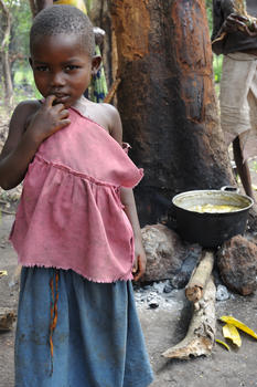 Niña con desnutrición en Orientale, República Democrática del Congo.