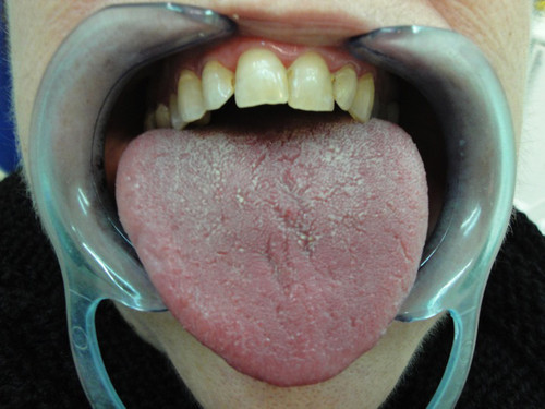 Aspecto de la lengua de una paciente con xerostomía. Foto: UGR.