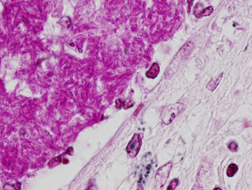 Muestra microscópica de un pulmón de enfermo de tuberculosis