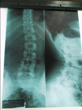 Radiografía de una columna vertebral con escoliosis.