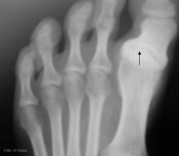 Radiografía del pie izquierdo de un paciente de 17 años que presuntamente padece el síndrome de Stickler. Se observa un juanete varus progresivo con una marcada osteoartritis en la base del juanete.