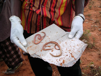 Una persona muestra varias lombrices intestinales.