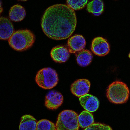 Células tumorales circulantes caracterizadas en base a la expresión de marcadores específicos para su eliminación con antitumorales anti-EGFR. Imagen: UGR.