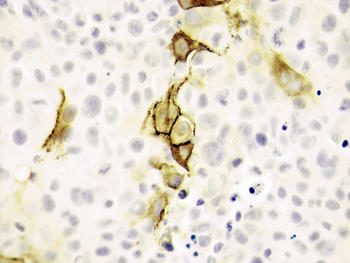 Las células de melanoma con los vectores virales -telomerasa- NIS. Se inyectaron en ratones que generaron tumores con expresión endógena de NIS. Los tumores disminuyeron en crecimiento y agresividad tras inyectar a los animales yodo radiactivo./CSIC