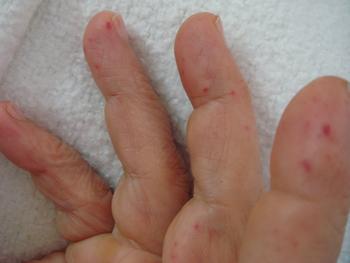 Microaneurismas en los dedos de una persona afectada por el síndrome de Rendu-Osler.