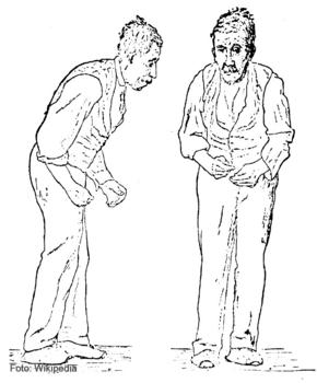 Esquema realizado por Richard Gowers en 1886 para explicar las manifestaciones físicas del párkinson.