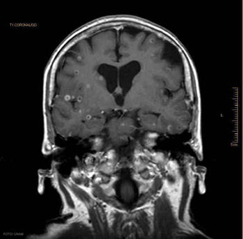 Tomografía computerizada de un individuo con neurocisticercosis.