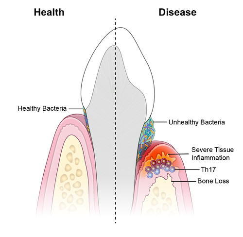 Diente sano (izquierda) y con la enfermedad. Imagen: N. Dutzan et al. Science Translational Medicine.