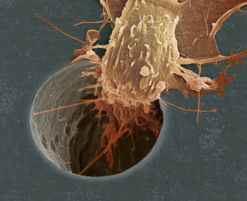 El cáncer es un proceso de crecimiento y diseminación incontrolados de células.