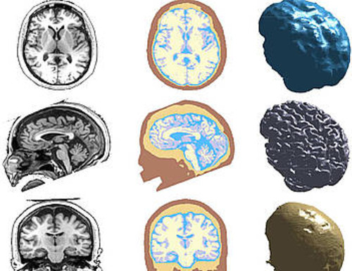 Segmentación de imagen médica de tejidos cerebrales a partir de resonancias magnéticas. FOTO: UN