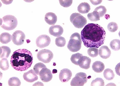 Neutrófilo y mileocito en un caso de Leucemia Mieloide.