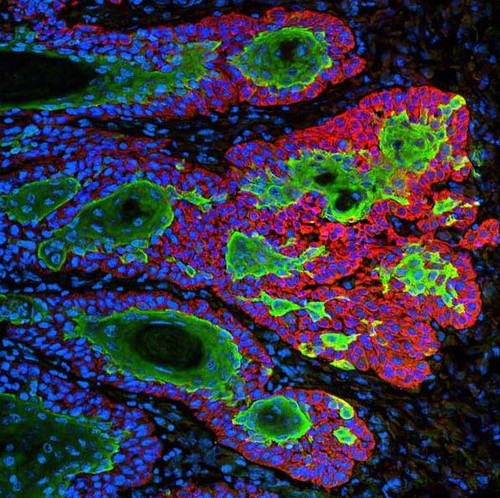 Carcinoma de células escamosas. Imagen: Markus Schober and Elaine Fuchs, The Rockefeller University.