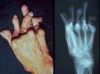 Deformaciones causadas por la artritis reumatoide