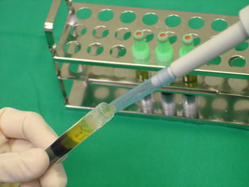 Fase de introducción de los factores de crecimiento en una jeringuilla para ser implantados en el paciente