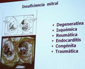 Diapositiva que muestra los tipos de insuficiencia mitral