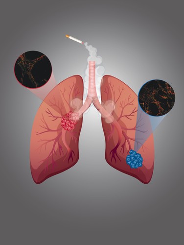 Cáncer de pulmón. Imagen: UB.