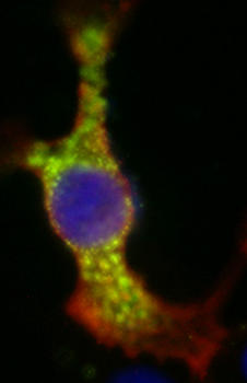 Célula tumoral infectada con NDV recombinante, en apoptosis. Imagen: Enrique Villar.