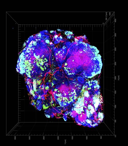 Tumor con zonas de hipoxia en color verde. / National Cancer Institute \ University of Chicago.