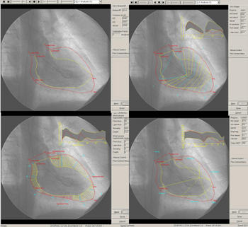 Medición de volúmenes ventriculares y de la fracción de eyección y determinación de la contractilidad regional (FOTO: Icicor).