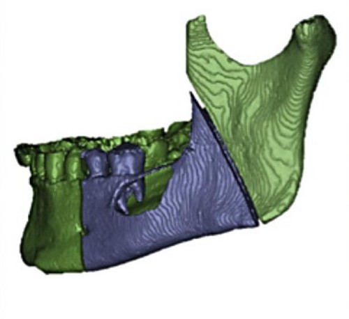 Mandíbula en 3D. Journal of Cranio-Maxillo-Facial Surgery.