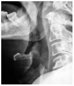Radiografía cervical lateral del paciente con calcificación en la epiglotis (Foto cedida por los autores del artículo).