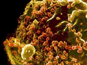 Linfocito T infectado por VIH