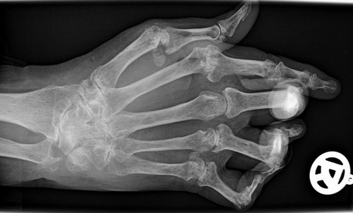 Radiografía de la mano de un paciente con artritis reumatoide (imagen: Wikipedia)