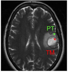 Cerebro afectado por un glioblastoma en el que se distingue la zona central de la masa tumoral (TM) de la zona periférica tumoral (PT). Imagen: Atanasio Pandiella.