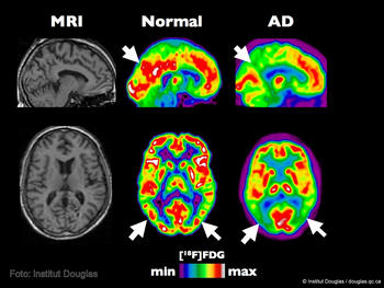 Diferencia entre un cerebro normal y otro afectado por la enfermedad de Alzheimer.