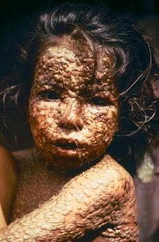 Esta niña se infectó de viruela en Bangladesh en 1973. Bangladesh fue declarado libre de la viruela en diciembre de 1977 cuando una comisión internacional de la OMS certificó oficialmente que la viruela había sido erradicada de ese país.