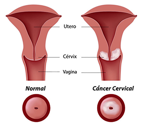 Cáncer de cuello uterino. FOTO:UN