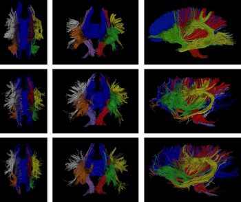 Tractos neuronales obtenidos con Resonancia Magnética de Difusión (FOTO: LPI).