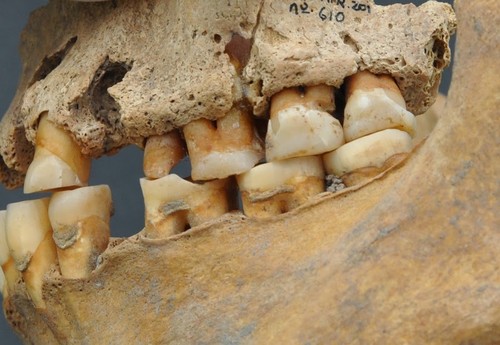 Imagen de la dentadura donde se observa el desgaste y otras incidencias - IPHES