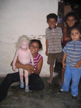 Niña con albinismo en Honduras.