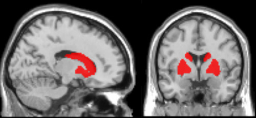 Los investigadores comprobaron por primera vez que la atrofia temprana en los ganglios de la base (una estructura del cerebro que primero se afecta en el Parkinson) se vincula con alteraciones en las redes corticales asociadas al lenguaje de acción.