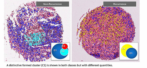 Agrupaciones de linfocitos predecirían recaídas por cáncer/Cristian Barrera