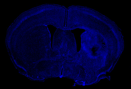 Hemorragia cerebral con lesión en el hemisferio derecho. Imagen: Neurobiología Molecular.