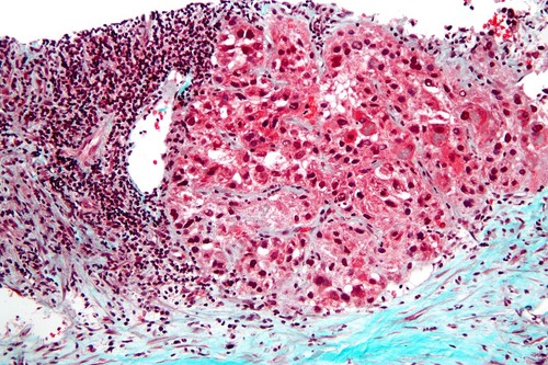 Carcinoma hepatocelular, el tipo más común de cáncer de hígado. / Wikipedia.