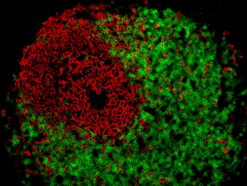 Folículo linfoide en el tejido adiposo mesentérico de un paciente con la enfermedad de Crohn que ilustra la presencia de células CD20 y CD3 positivas/archivo de los investigadores