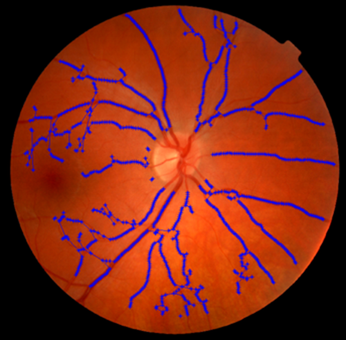 Análisis de la ramificación de venas y arterias en la retina. Imagen: Centro de Salud La Alamedilla.