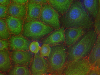 Inmunofluorescencia de células de carcinoma escamoso. En verde, el citoesqueleto de filamentos intermedios; en rojo, una proteína de adhesión relacionada con la metástasis y en azul los núcleos celulares con una tinción para DNA (DAPI)./ CIEMAT
