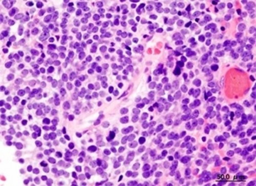 Linajes de meduloblastoma, el tipo de cáncer cerebral más común en niños (imagen: Wikimedia Commons)