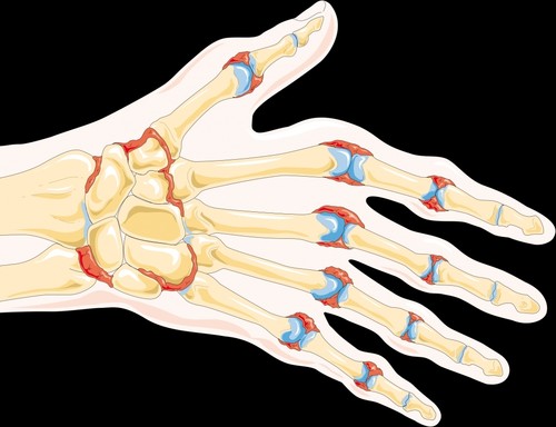 Artritis reumatoide/Wikipedia Commons