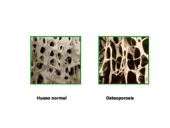 Imagen de la porosidad de los huesos, el de la derecha afectado por osteoporosis (Foto cedida por el doctor Pérez Castrillón)