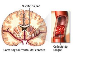 El coágulo sanguíneo puede obstruir el paso de la sangre a través de una arteria cerebral