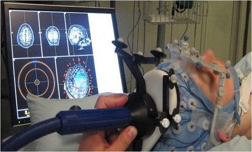 Procedimiento TMS-EEG (estimulación magnética transcraneal + electroencefalografía).